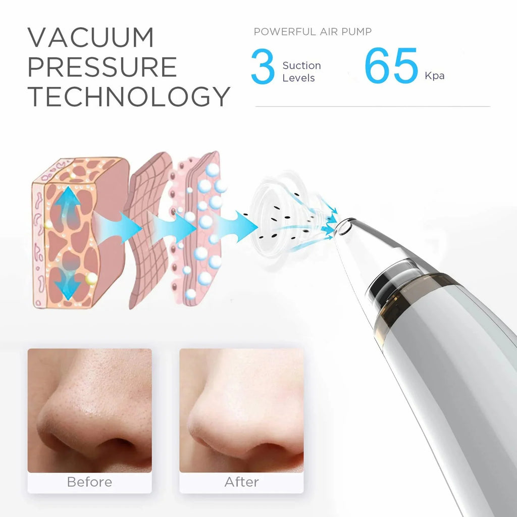 Upgraded Version Blackhead Remover Pore Vacuum Cleaner Pimple Extractor - Facial Pore Cleaner Pore Extractor, USB Rechargeable Blackhead Remover Vacuum with 5 Probes