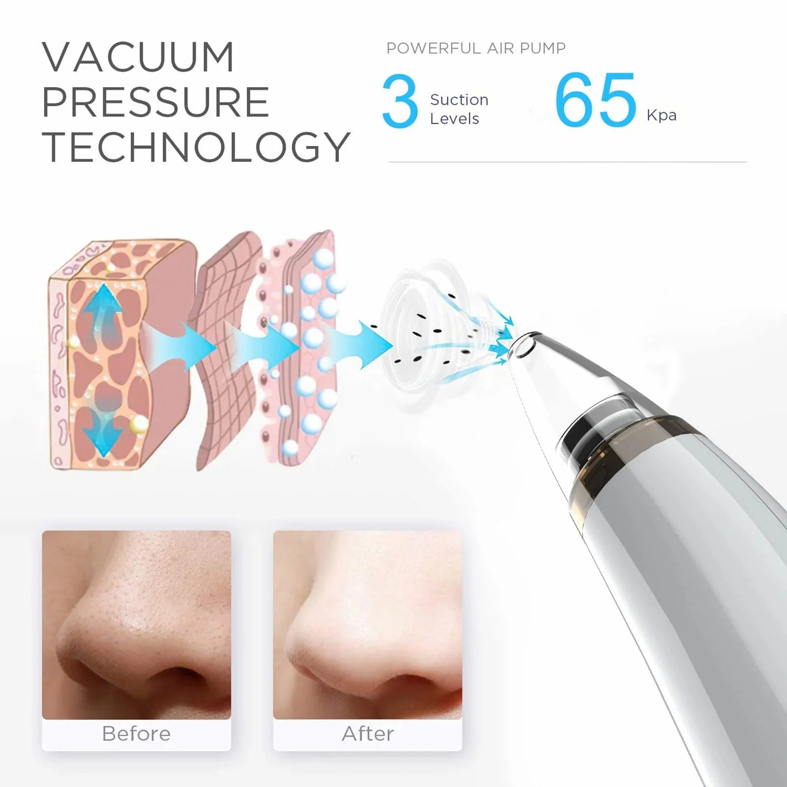 Upgraded Version Blackhead Remover Pore Vacuum Cleaner Pimple Extractor - Facial Pore Cleaner Pore Extractor, USB Rechargeable Blackhead Remover Vacuum with 5 Probes